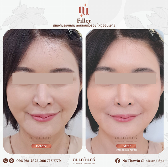 filler (แก้ม ลดริ้วรอย)