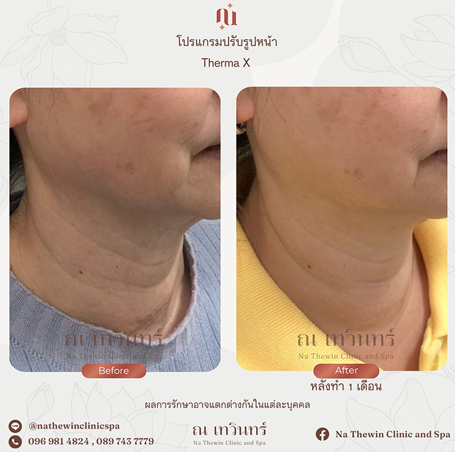 รีวิว therma X
