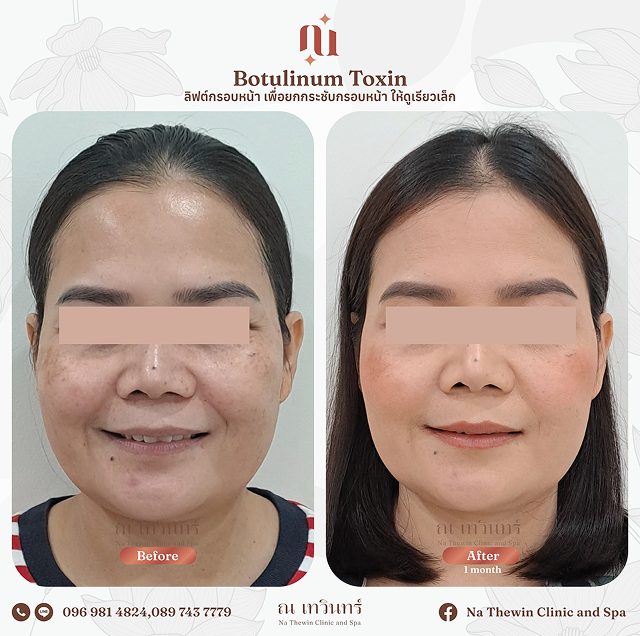 ลิฟต์กรอบหน้า รีวิว